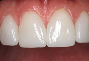 Utopia Dental Arts | Veneers, Ceramic Crowns and Emergency Treatment