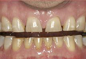 Utopia Dental Arts | Dental Bridges, Ceramic Crowns and Dentures